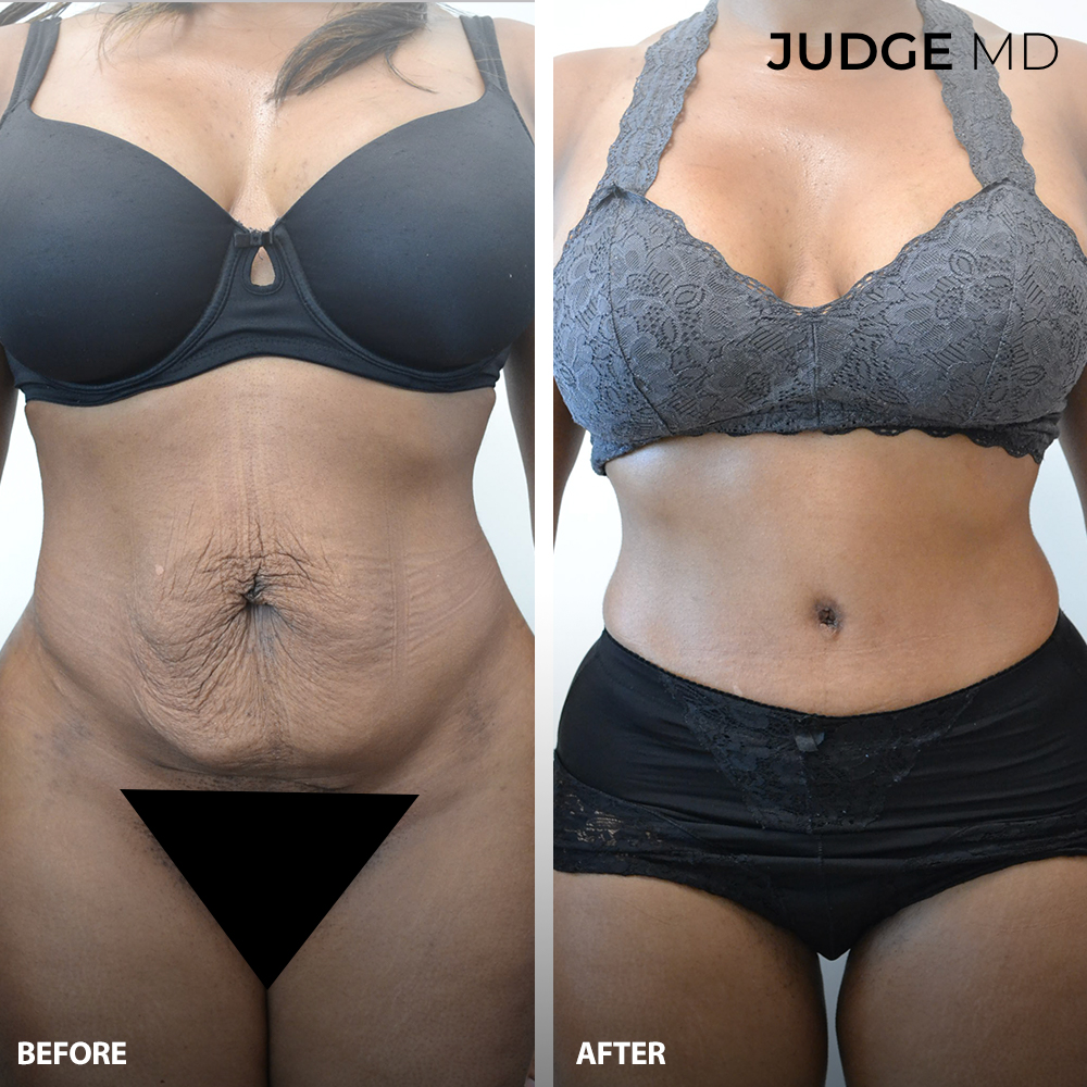 Before and after an abdominoplasty