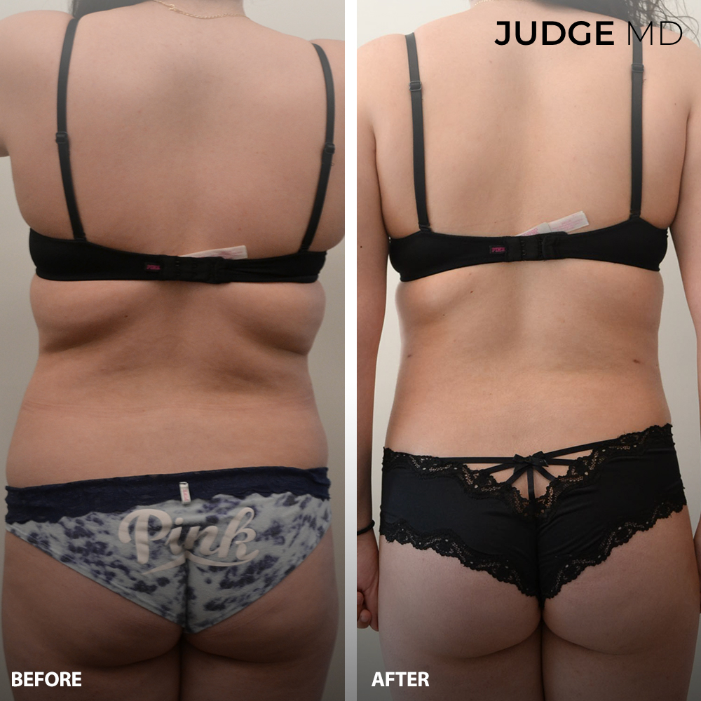 Before and after liposuction