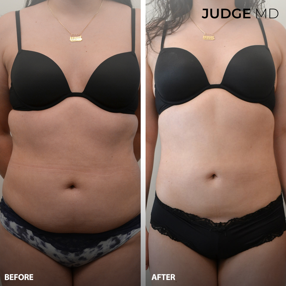 Before and after liposuction