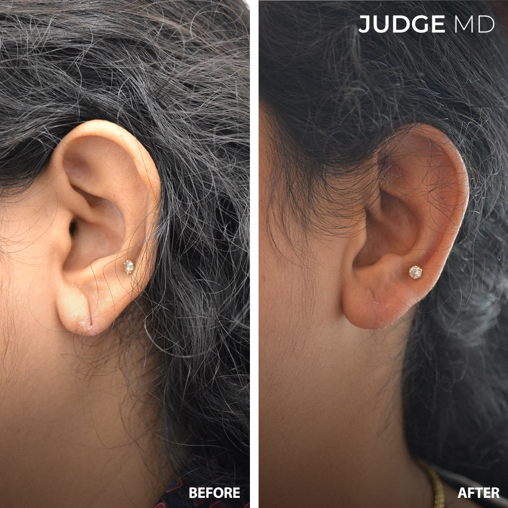 Earlobe Repair / Ear Reshaping before and after