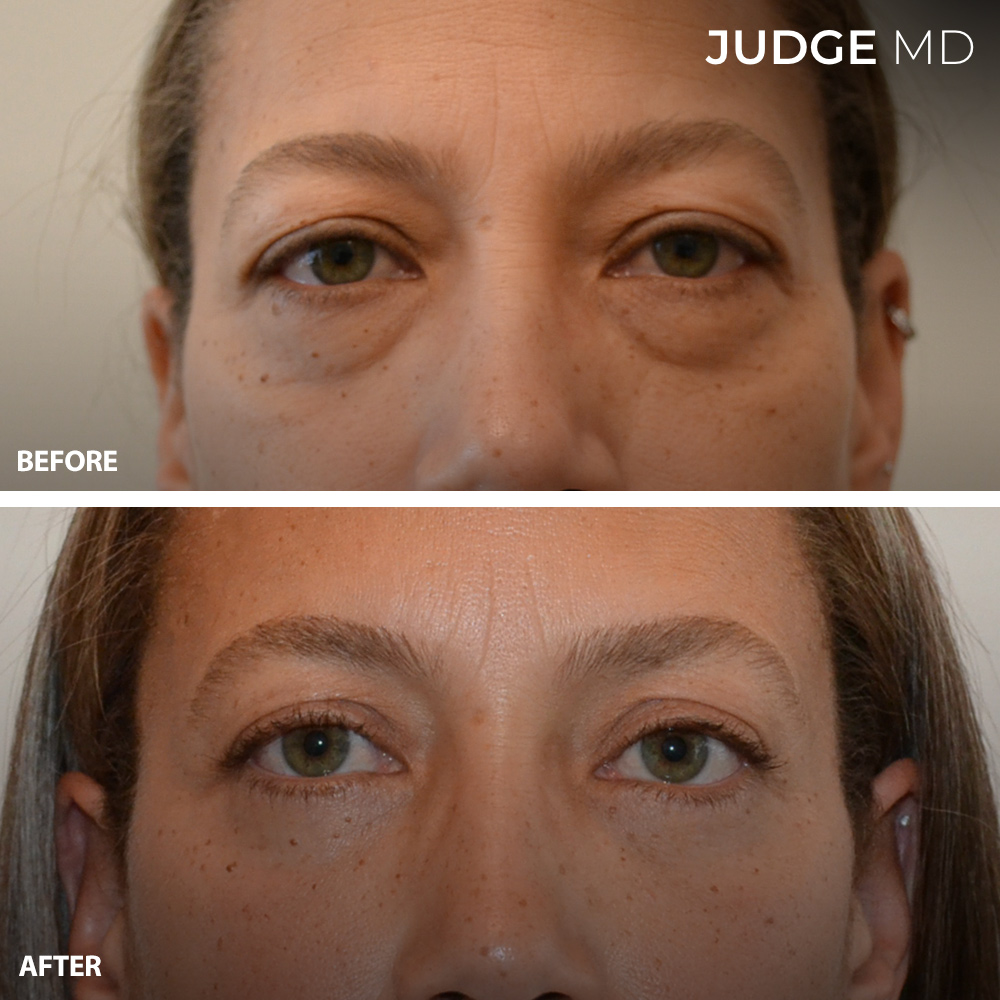 Before and after blepharoplasty