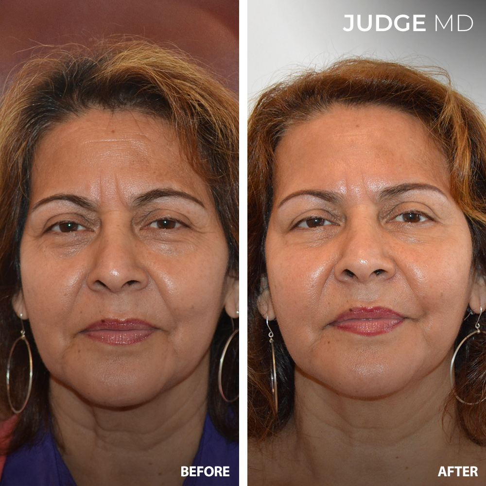 Before and after Sculptra