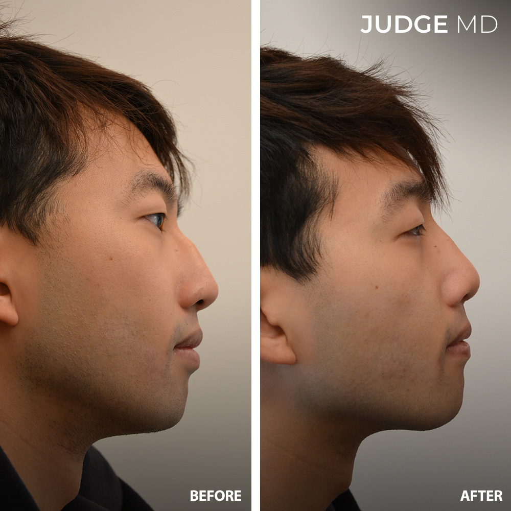 Before and after rhinoplasty