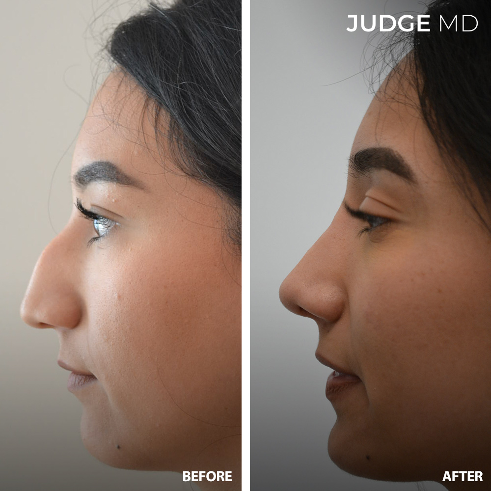 Before and after rhinoplasty